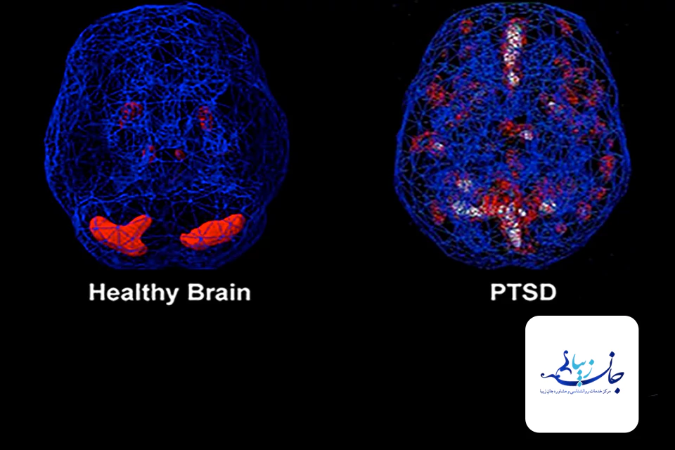 Post-traumatic stress disorder