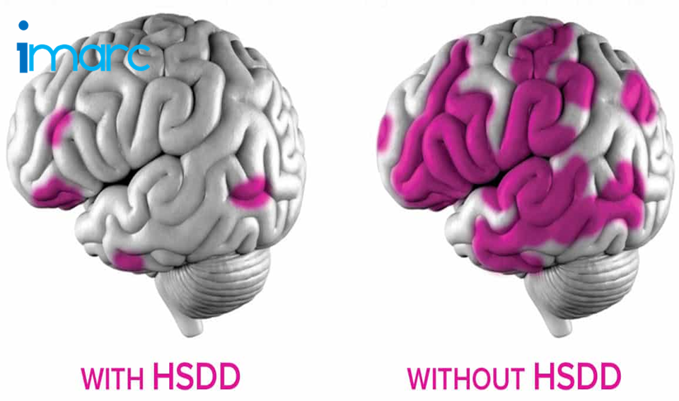 کاهش میل جنسی در زوجین؛ 12 دلیل مهم و راهکارهای درمان کاهش میل جنسی